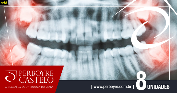 O papel da radiografia na determinação ou não da extração do dente siso.